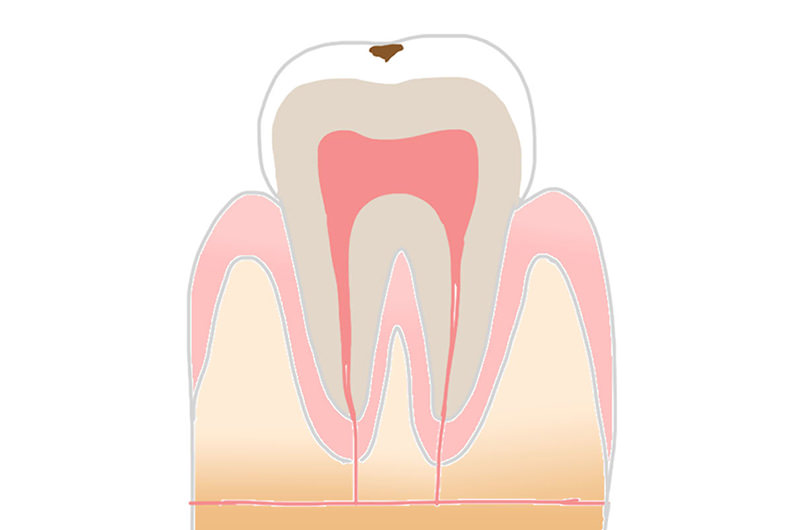 C1：エナメル質の虫歯